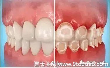 如何避免矫牙后的白斑和蛀牙？#葉子口腔科普#