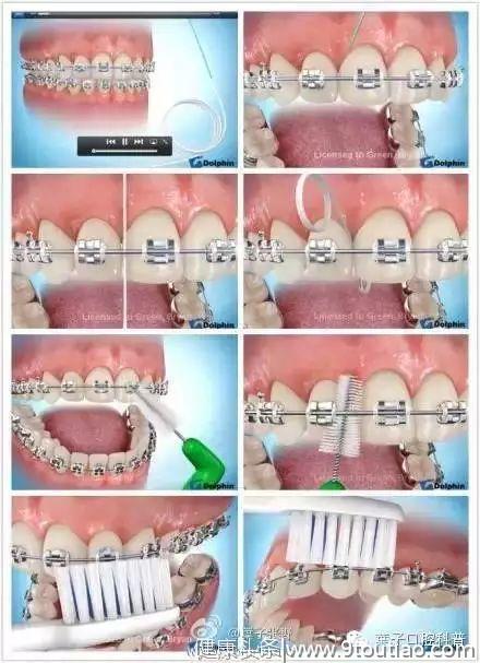 如何避免矫牙后的白斑和蛀牙？#葉子口腔科普#