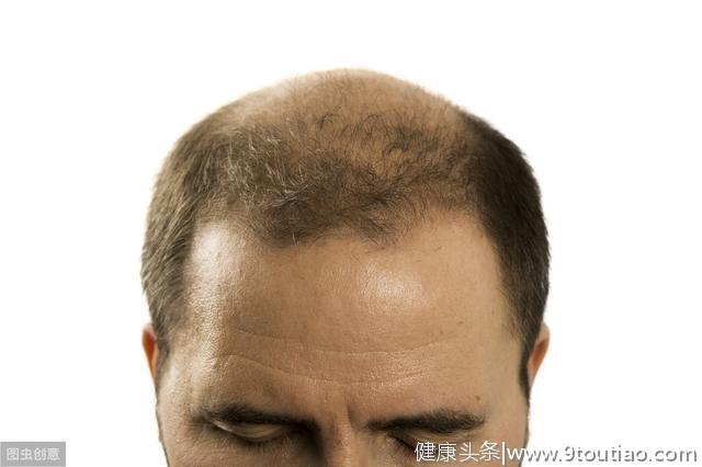 遗传性脱发没法治？这几种办法，用对了头发还有救！