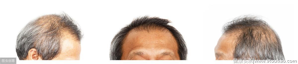 遗传性脱发没法治？这几种办法，用对了头发还有救！