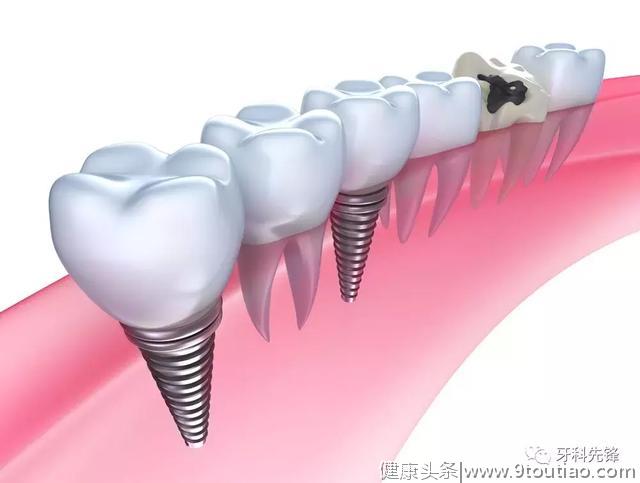 种植牙手术前、中、后应该注意哪些事项？