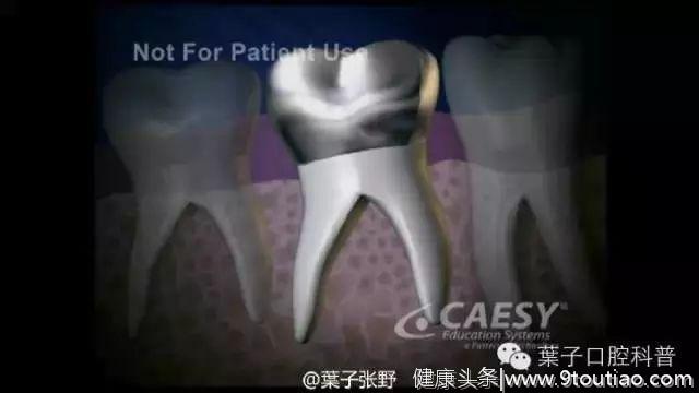 乳牙蛀牙严重，但是牙不疼，需要“杀神经”吗？#葉子口腔科普#