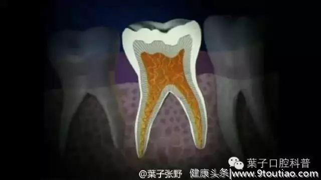 乳牙蛀牙严重，但是牙不疼，需要“杀神经”吗？#葉子口腔科普#