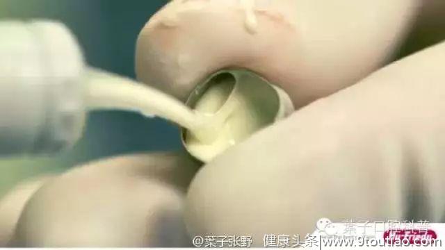 乳牙蛀牙严重，但是牙不疼，需要“杀神经”吗？#葉子口腔科普#