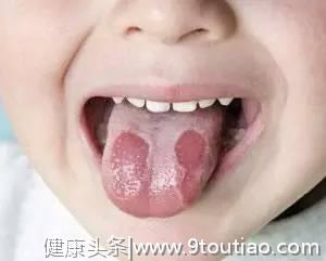 孩子嘴里出现小水疱、双排牙等异常，该如何处理？葉子口腔科普