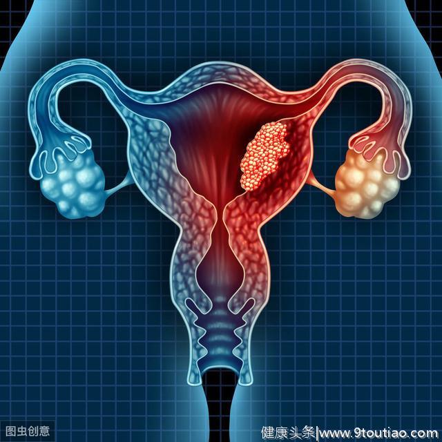 宫颈癌初期，会有“3个信号”，因此，预防宫颈癌十分重要