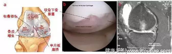 “滑膜炎”，“骨质增生”和“关节炎”是否同一种病？如何治疗？