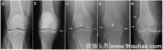 “滑膜炎”，“骨质增生”和“关节炎”是否同一种病？如何治疗？