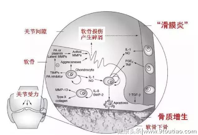 “滑膜炎”，“骨质增生”和“关节炎”是否同一种病？如何治疗？