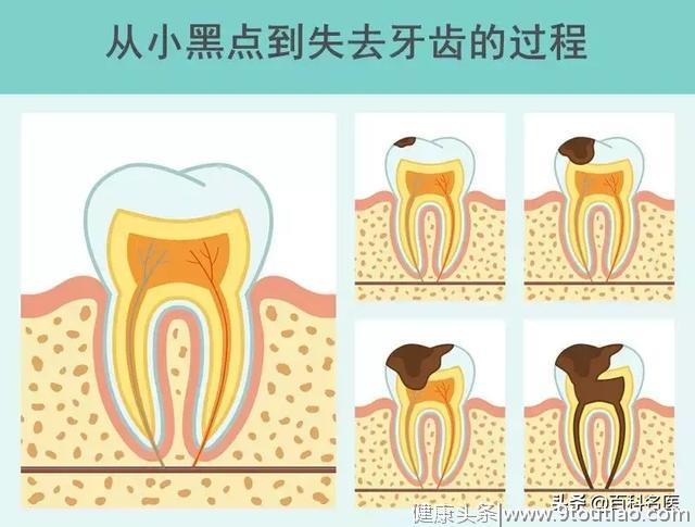 牙齿上的小黑点为啥抠不掉？今天告诉你真相