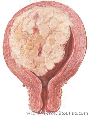检查提示子宫肌瘤变性，是不是变成癌了？