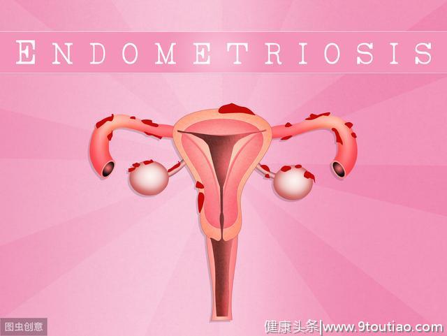 患子宫内膜异位的女人，身体会出现4个症状，抓紧去医院查一下！