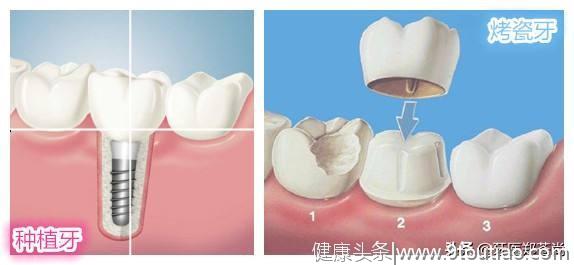 牙齿缺失哪种修复方法好？