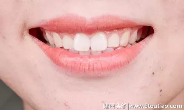 60岁后牙齿深黄 异味大 做好四点 牙齿能变白
