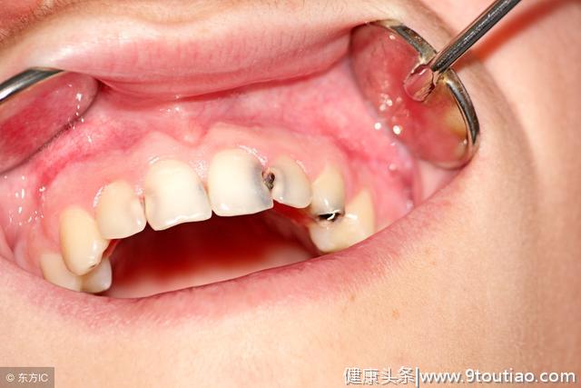 拔11颗牙造成孩子终生心理阴影！儿童乳牙期常见问题，父母要重视