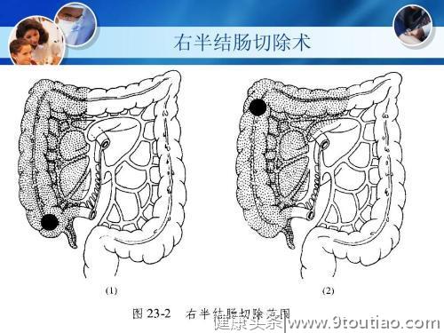 央视主持人直肠癌去世，人到中年怕肠癌，千万不要忽视这一点！