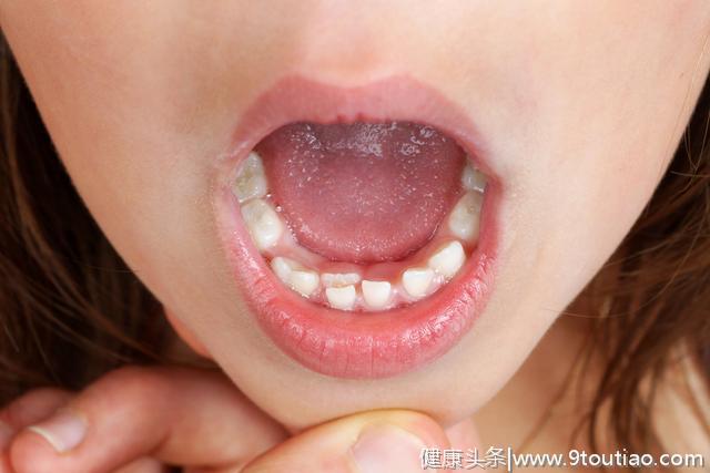 孩子牙齿六大常见问题，这里解决方法很全，家长们注意到了吗？