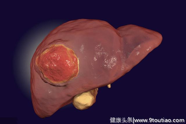 48岁女子从不喝酒，查出肝癌，2样东西吃太多，很容易惹癌上身！