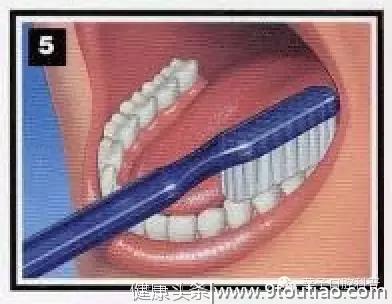 暴力刷牙导致楔状缺损，正确刷牙