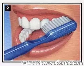 暴力刷牙导致楔状缺损，正确刷牙