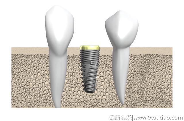 靖佳齿科即将推出黑科技，让每一位牙医都能轻松开展种植项目