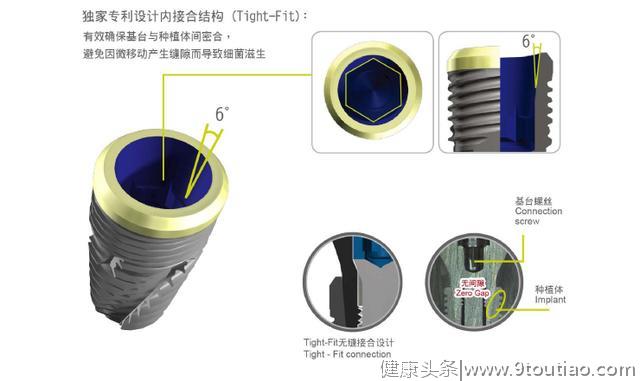 靖佳齿科即将推出黑科技，让每一位牙医都能轻松开展种植项目