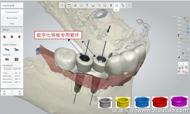 靖佳齿科即将推出黑科技，让每一位牙医都能轻松开展种植项目