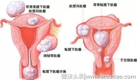女人长了子宫肌瘤，会有什么症状？注意五点，或能避免肌瘤变大