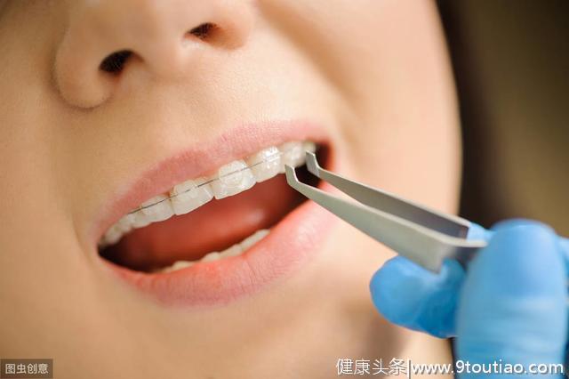 常见的牙齿矫正方式有这四种
