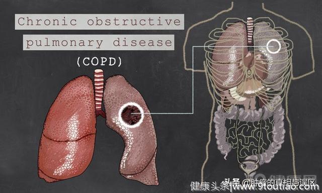 什么样的肺部结节是肺癌？用三个症状告诉你