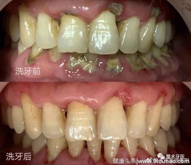 牙周炎，中国成年人后半生永远的痛！