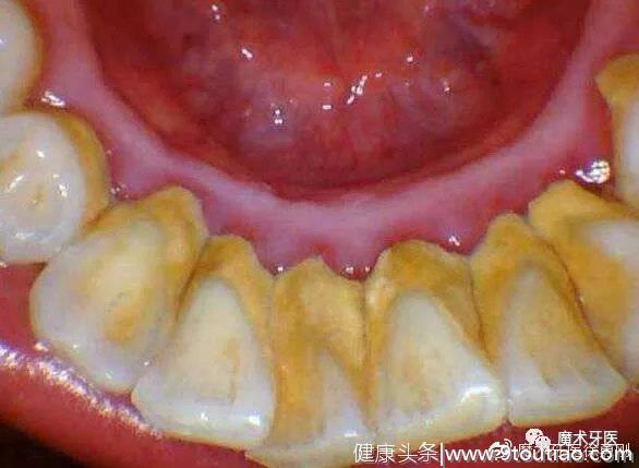 牙周炎，中国成年人后半生永远的痛！