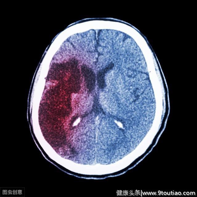 高血压若有3个迹象，或是脑出血的征兆暗示