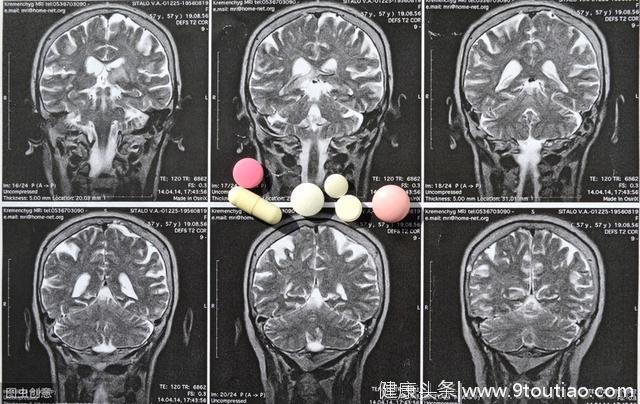 高血压若有3个迹象，或是脑出血的征兆暗示