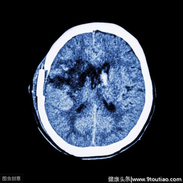 高血压若有3个迹象，或是脑出血的征兆暗示