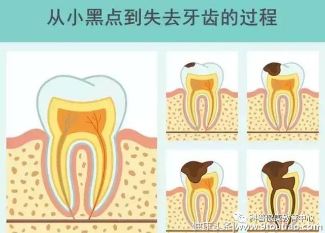 牙齿上的小黑点为啥抠不掉？今天给你科普真相