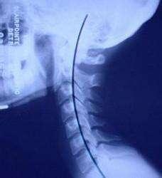脖子肩背痛有颈椎病，骨科医生告诉你：颈椎日常保养这2点最重要