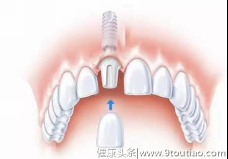 种植牙的十万个为什么，济宁丁香树口腔为你一一解答！