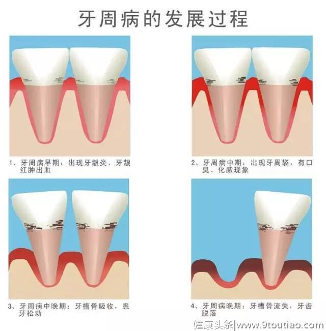 这项口腔疾病是仅次于癌症的第二大疾病！