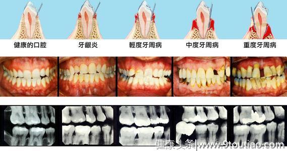 这项口腔疾病是仅次于癌症的第二大疾病！