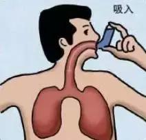 哮喘：世界上3亿人生命受到威胁，但这类人久咳不喘，最易漏诊！