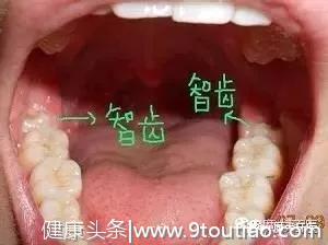 智齿到底该不该拔？作为牙医我坦诚爆料！