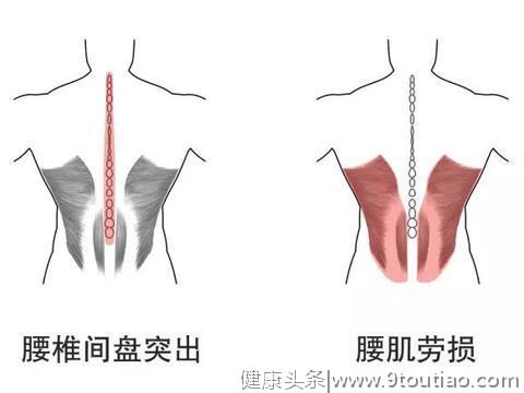 腰疼有可能是哪些疾病？5个细节告诉您腰怎么“养”！