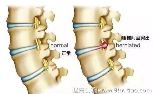 腰疼有可能是哪些疾病？5个细节告诉您腰怎么“养”！