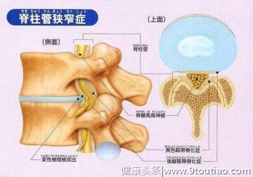 腰疼有可能是哪些疾病？5个细节告诉您腰怎么“养”！