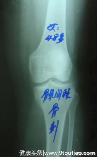 骨科医生科普骨质增生：骨刺并不疼，疼痛是其他原因引起的