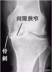 骨科医生科普骨质增生：骨刺并不疼，疼痛是其他原因引起的