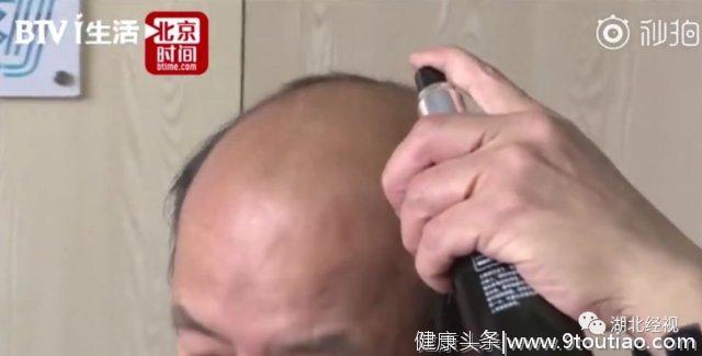 脱发男坚持使用生发秘方，5个月后头发全没了…