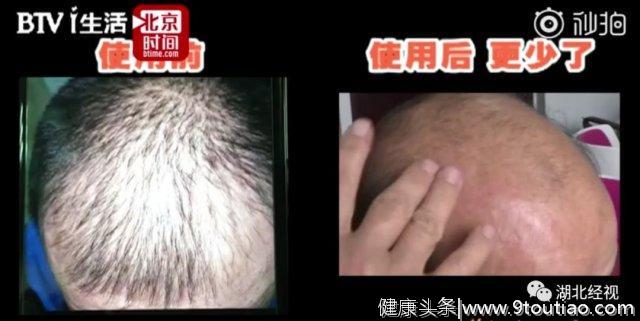 脱发男坚持使用生发秘方，5个月后头发全没了…