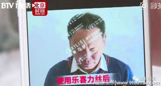 脱发男坚持使用生发秘方，5个月后头发全没了…